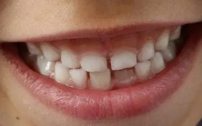 Don’t Let the Holidays Compromise Your Pearly Whites