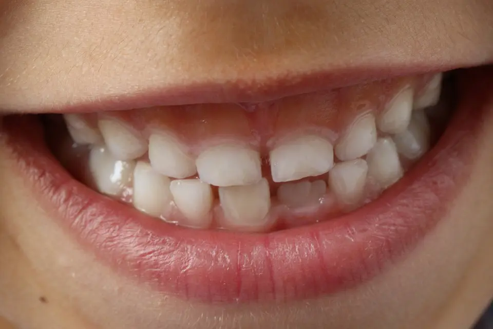 Lowering Your Child's Risk for Cavities Lowering Child's Risk for Cavities