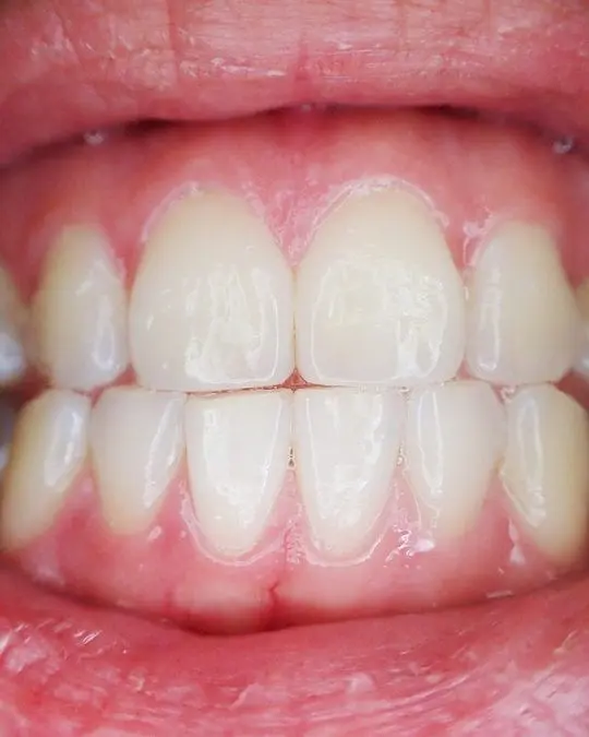 The Facts About Gum Disease