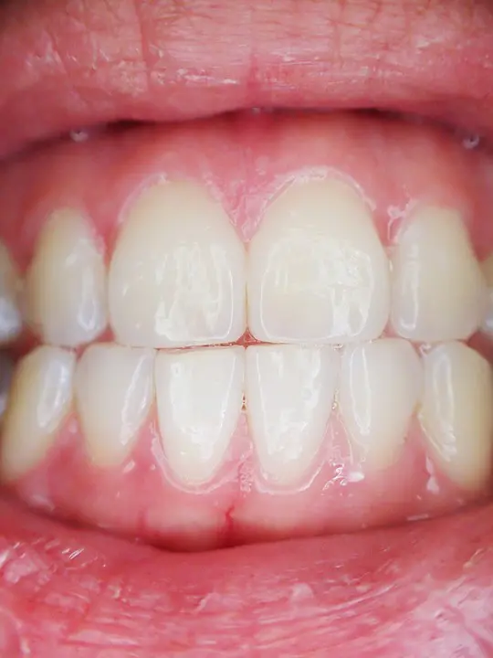 The Facts About Gum Disease Gum Disease