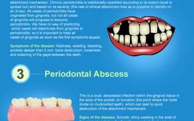 Types of Gum Disease [infographic]