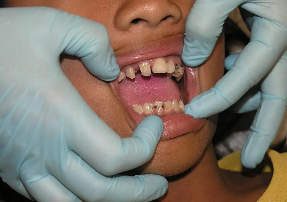 Why Do I Get So Many Cavities?
