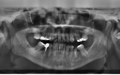 Can Your Wisdom Teeth Stay In?