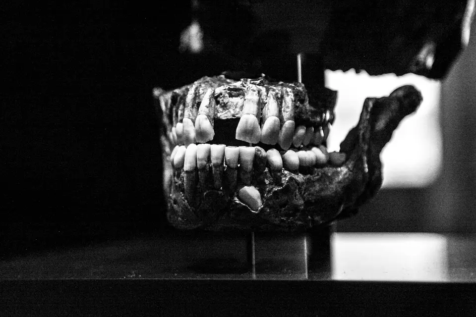 Adult teeth falls out Adult teeth falls out
