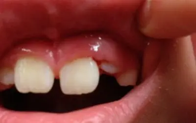 Do You Have Gum Disease?