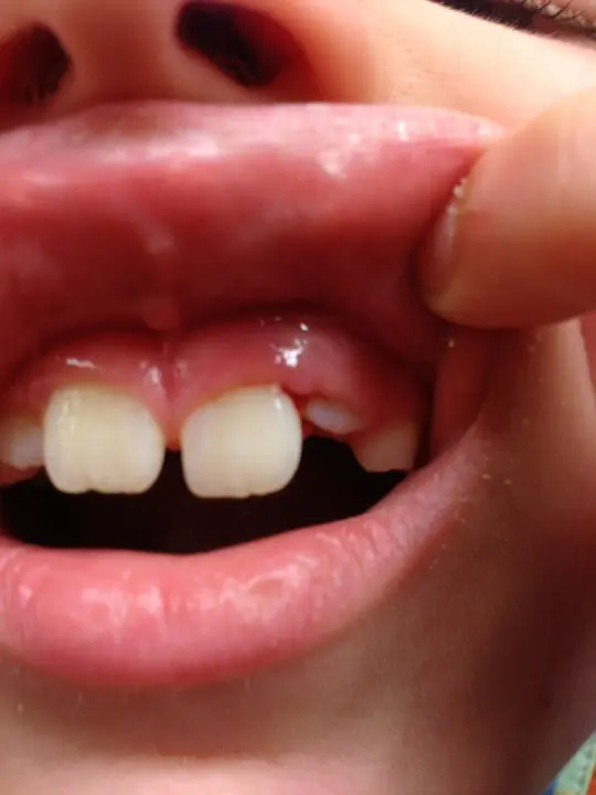 gum disease gum disease