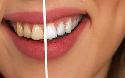 Are Your Teeth Yellow?