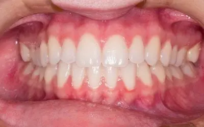 Gingivitis vs. Periodontitis