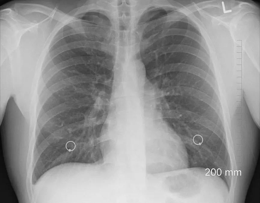 The Effects of Lung Cancer Treatment on Oral Health