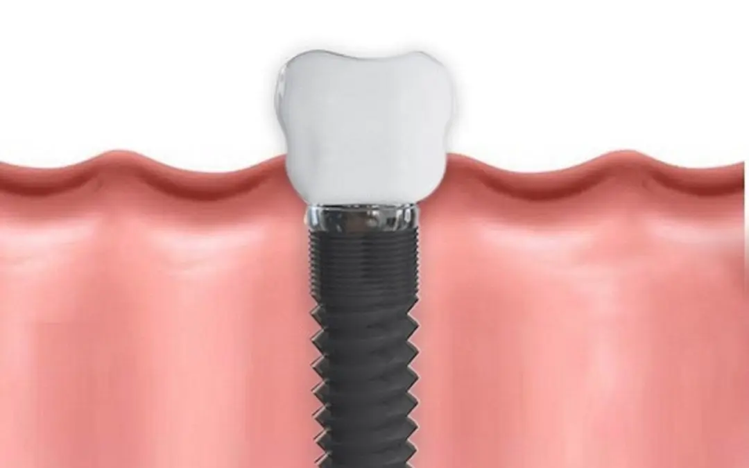 Is a Dental Implant or Bridge Right for You?