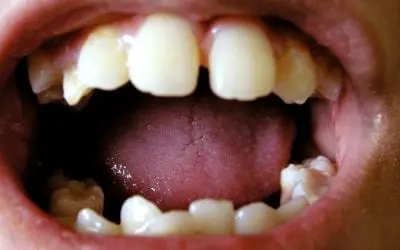 Do Your Gums Bleed?
