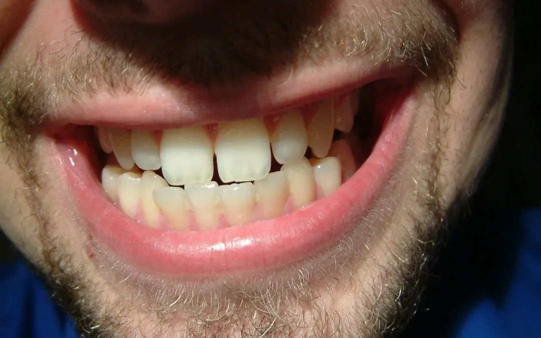 How to Deal with Grinding Your Teeth