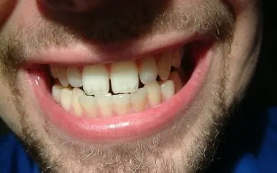 How to Deal with Grinding Your Teeth