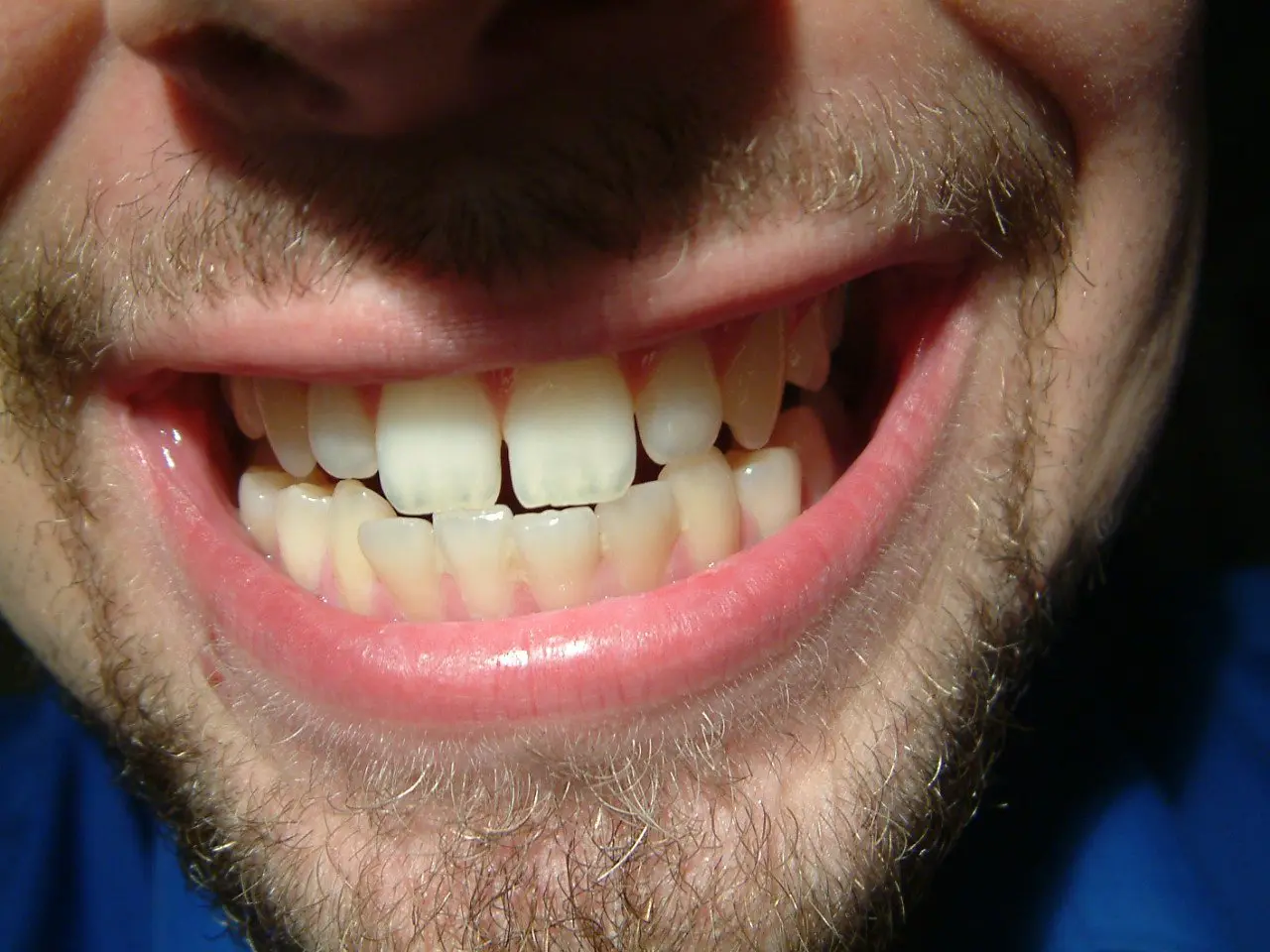 Deal with Bruxism Deal with Bruxism
