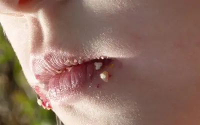 Why Does My Child Have Bad Breath?