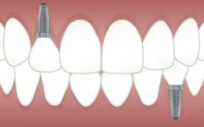 Common Dental Implant Issues