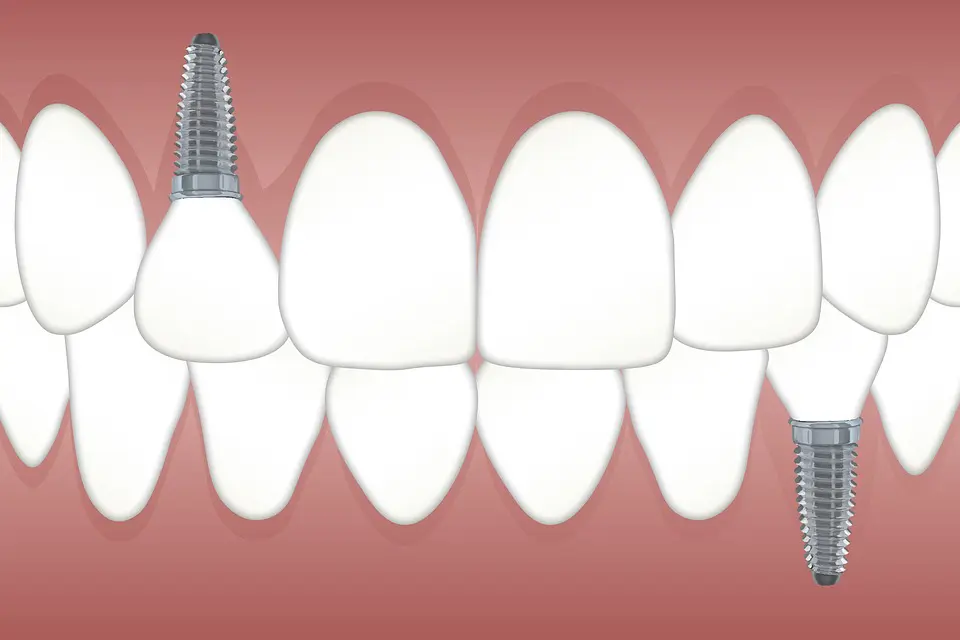 Common Dental Implant Issues Common Dental Implant Issues