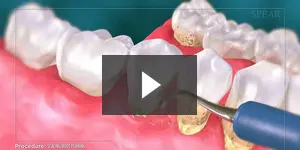tooth filling