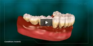 Periodontitis
