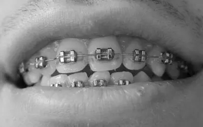 Braces vs. Invisalign