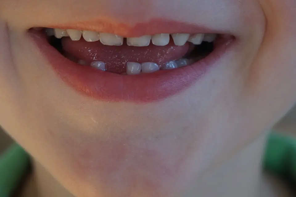 Sedation Dentistry for Kids