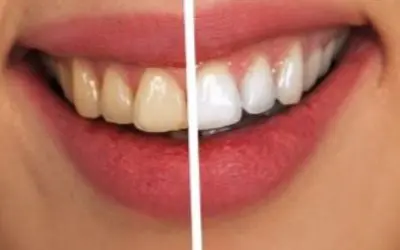 The Lowdown on Yellow Teeth