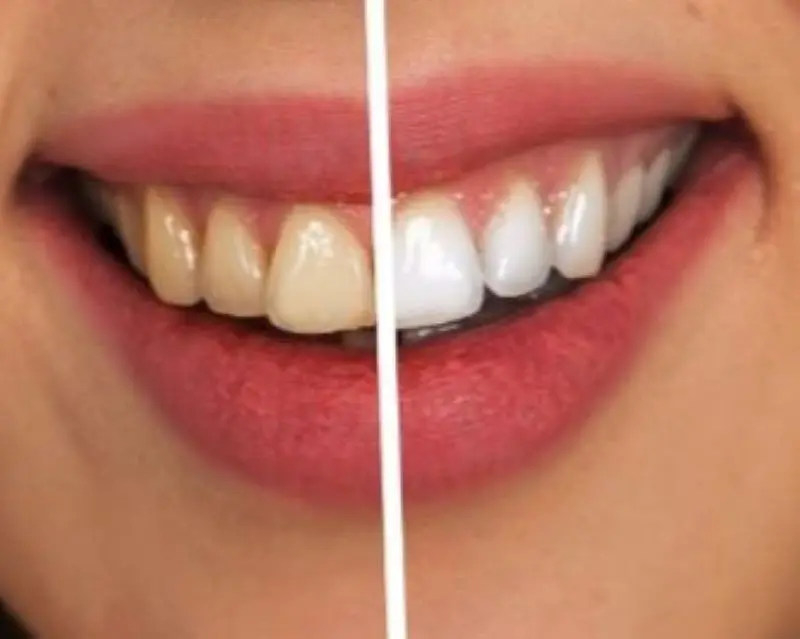 The Lowdown on Yellow Teeth