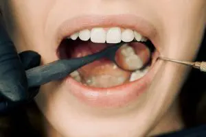 Why Tooth-Colored is the Way to Go Why Tooth-Colored is the Way to Go