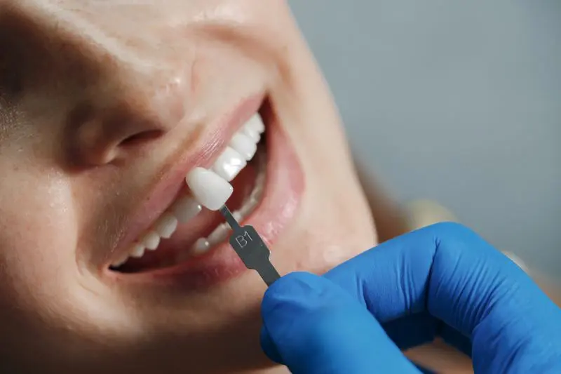 The Lifespan of Dental Veneers: Beauty That Lasts