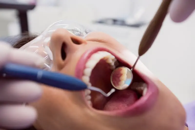 What to Expect Before and After Dental Fillings