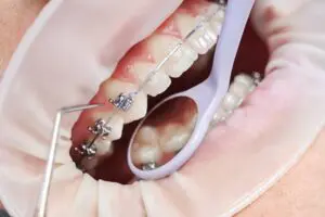 How Do Dental Sealants Work?