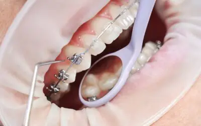 How Do Dental Sealants Work?