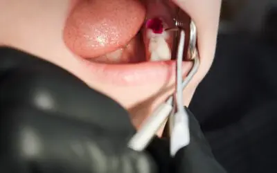 Do I Need Inlays or Onlays for My Damaged Teeth?