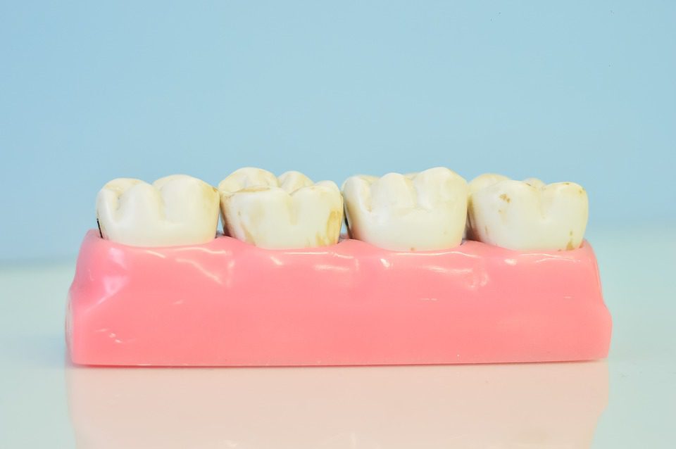 Abscessed Tooth Abscessed Tooth