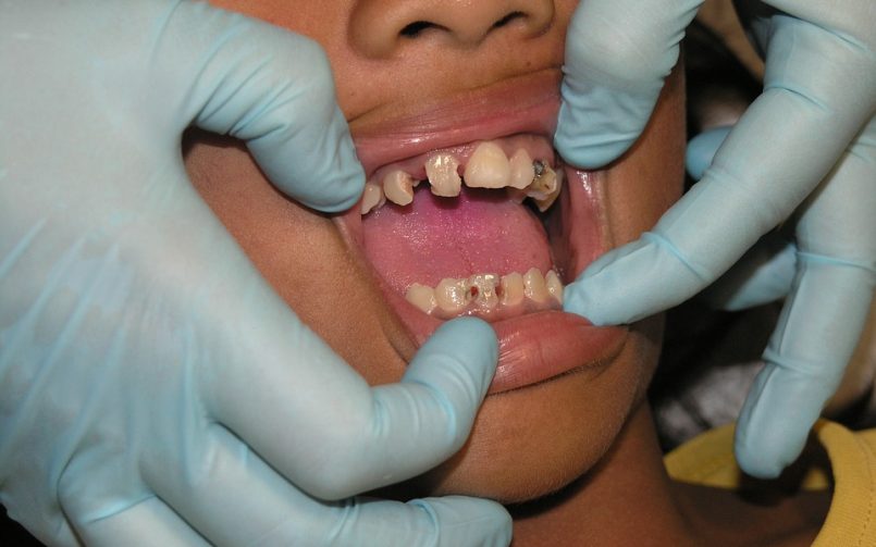 Cause of Cavities