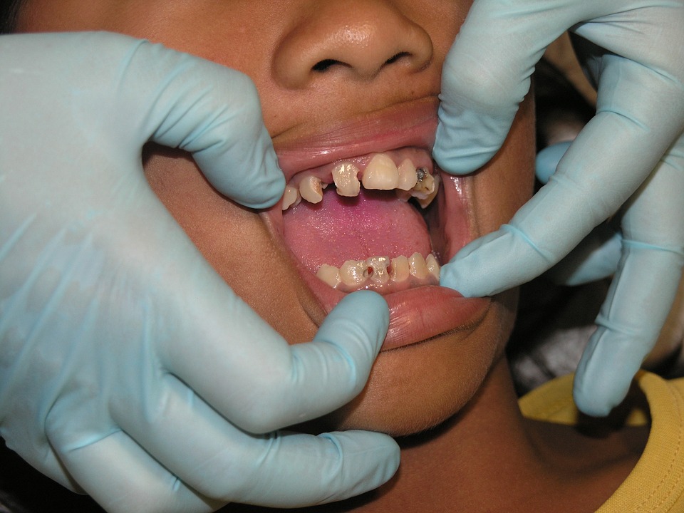 Cause of Cavities
