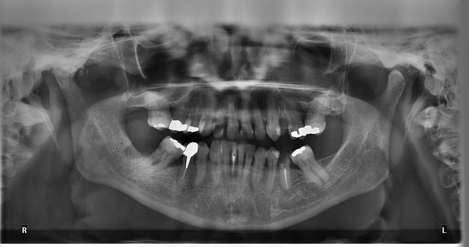 Can Wisdom Teeth Stay in Can Wisdom Teeth Stay in