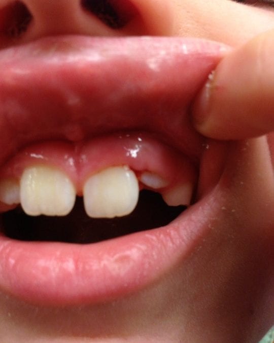 Do You Have Gum Disease?