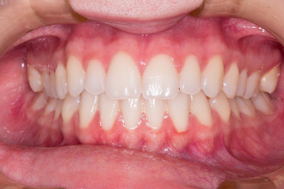 Gingivitis vs. Periodontitis