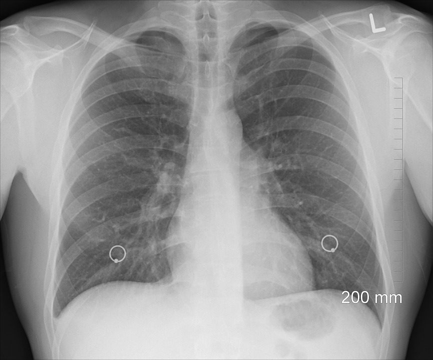 Effects of Lung Cancer Treatment on Oral Health