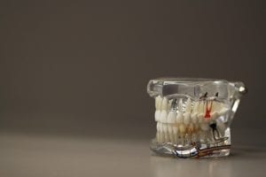 Options for Dental Implants