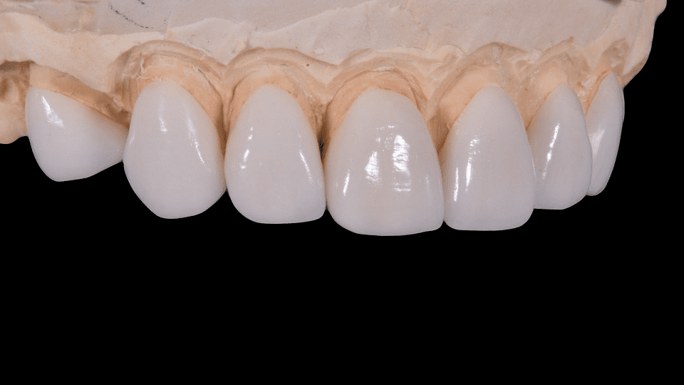 Different Types of Dental Crowns