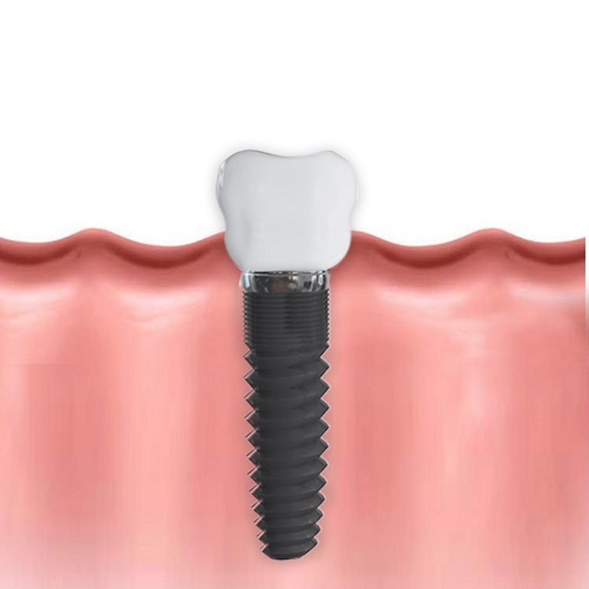Dental Implant or Bridge