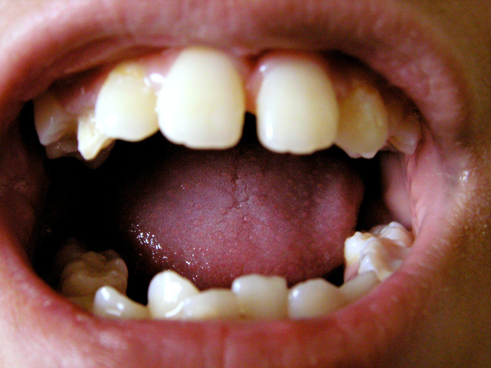 Gums Bleed Gums Bleed