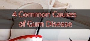 4 Common Causes of Gum Disease [infographic]