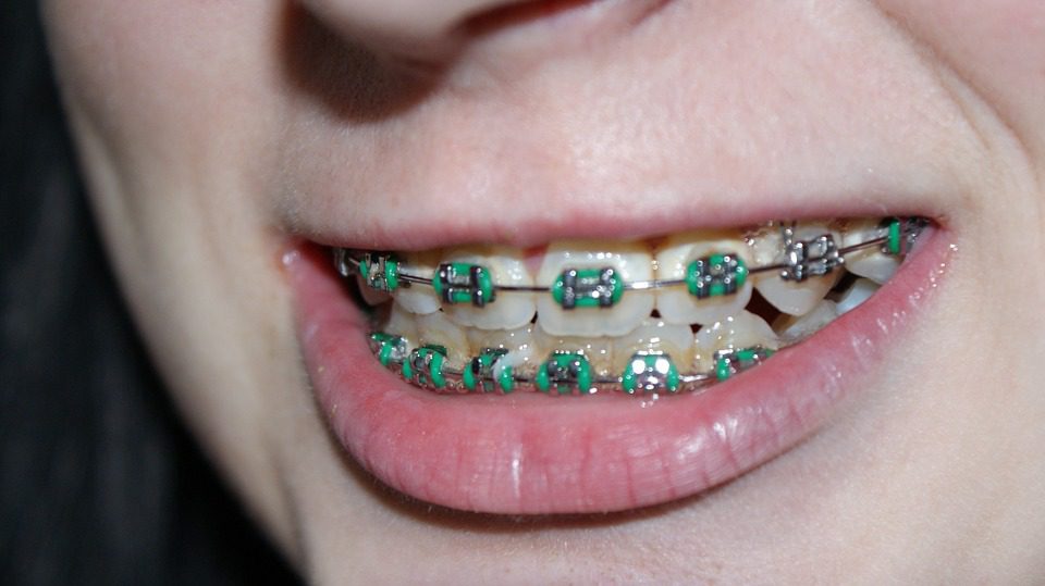 Kids Crooked Teeth Kids Crooked Teeth