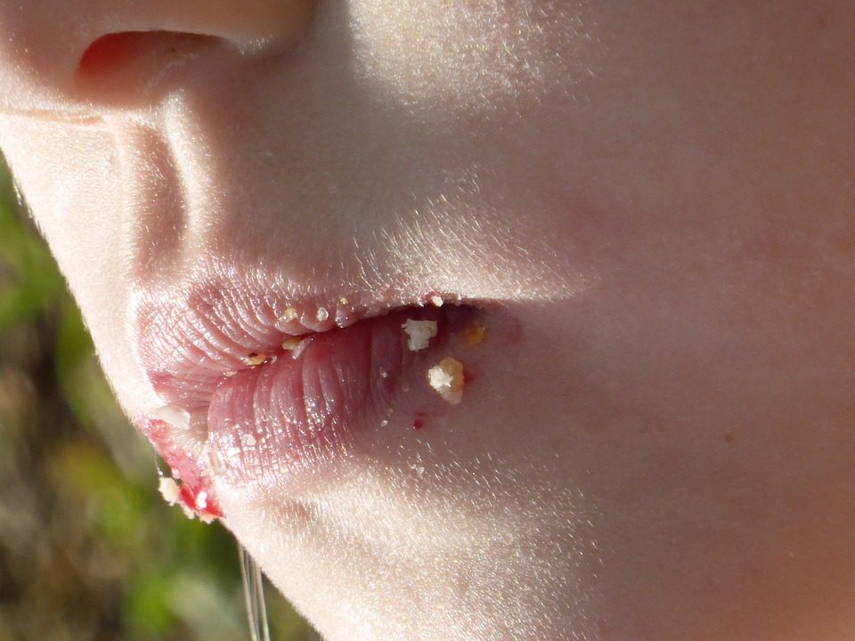 Child Bad Breath Child Bad Breath
