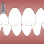 Common Dental Implant Issues