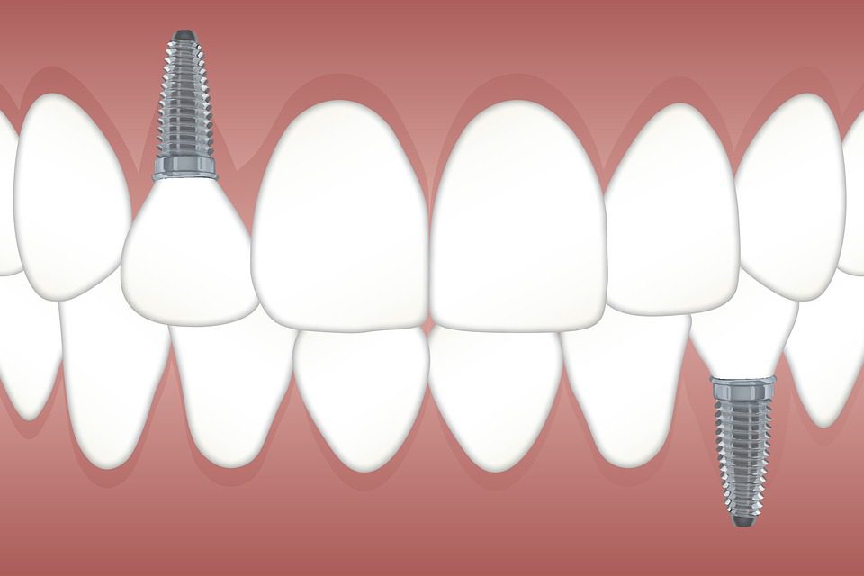 Common Dental Implant Issues