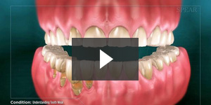 Understanding Tooth Wear
